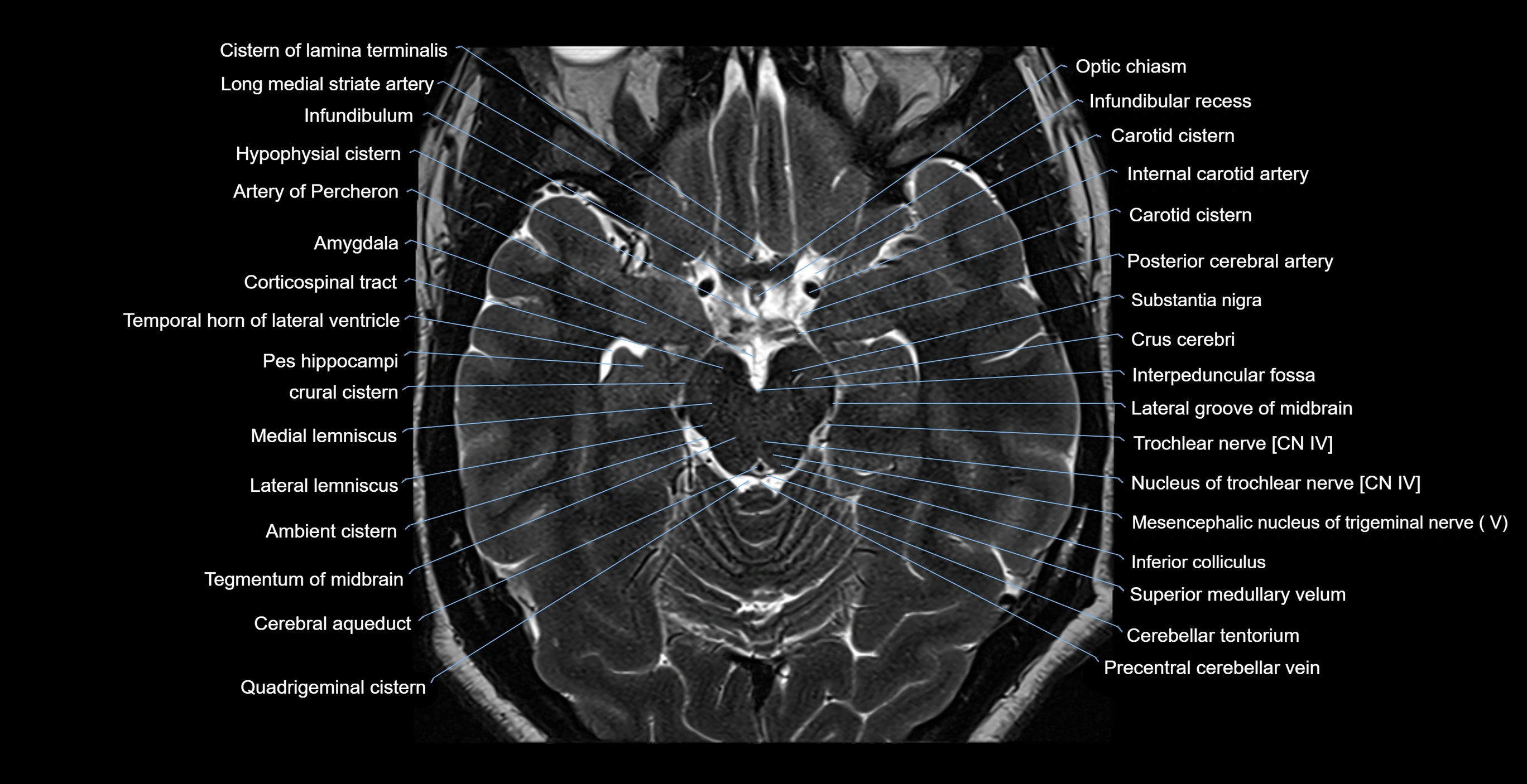 brain axial anatomy 3T MRI images -img-17001-00023.webp